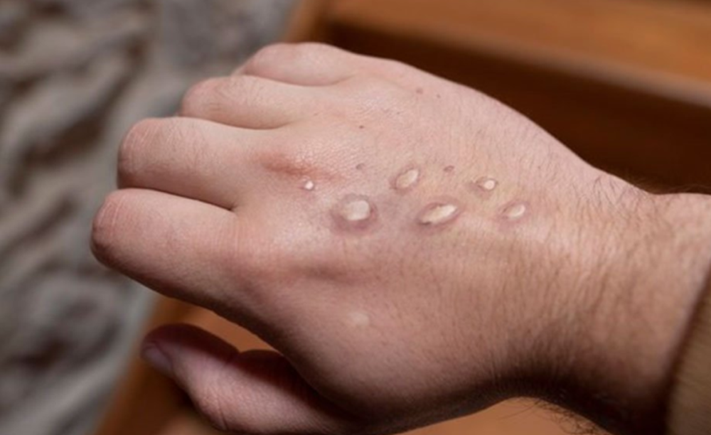 La erupción característica que causa la viruela del mono.