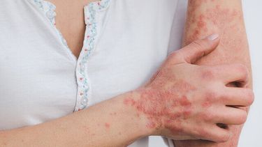 La enfermedad psoriásica es una afección crónica, inflamatoria, no contagiosa del sistema inmunológico que puede afectar no solo a la piel (psoriasis), sino también a las articulaciones (artritis psoriásica).