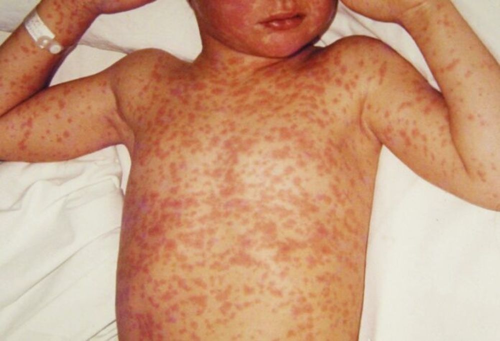 En bebés y niños pequeños el sarampión puede llegar a ser mortal.