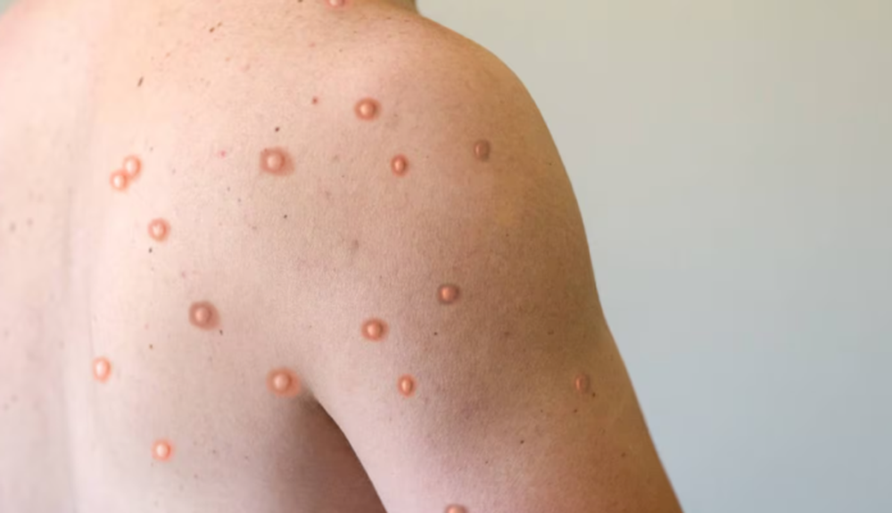 La viruela símica se contagia por contacto piel con piel con otras personas y las gotículas que se exhalan al respirar o toser.