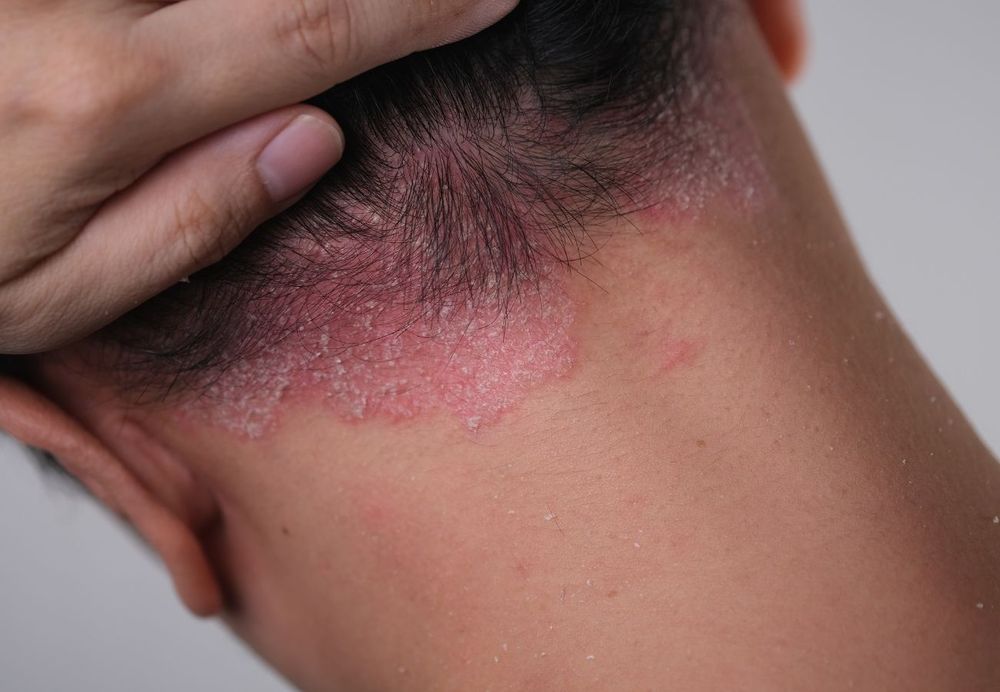 Novedades sobre dermatitis atópica.