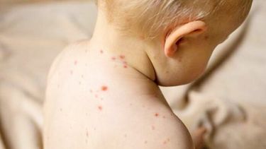 La historia de la SVA se remonta a la propuesta que los Ministros de Salud de la Sub Región Andina presentaron en el 2002, a raíz del último brote de sarampión endémico que ocurrió en el continente.