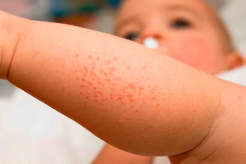 La dermatitis atópica afecta al diez por ciento de los niños y adolescentes, y en muchos casos llega hasta la adultez.