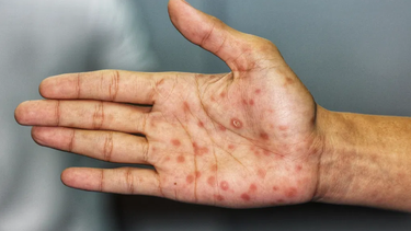 Los casos de sífilis subieron un 20% en el país durante el último año.