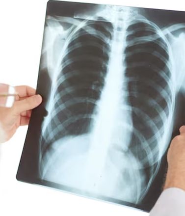 Cuando un nódulo es pequeño, como el que tendría el papa León XIV, la probabilidad de que se trate de un cáncer es baja.