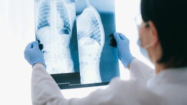 El cáncer de pulmón es la principal causa de muerte por cáncer a nivel mundial.