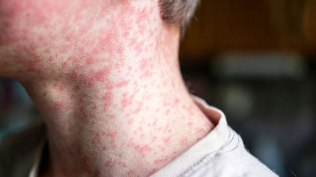 La vacunación contra el sarampión, fundamental para cortar las cadenas de contagio.