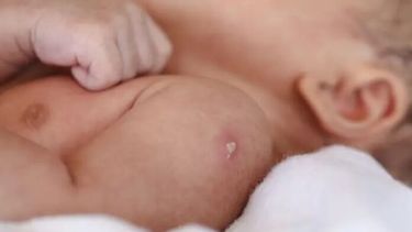 La marca que deja la vacuna BCG en los bebés.