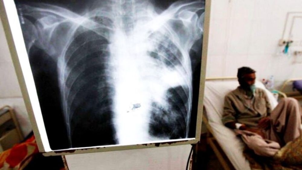 Los casos de tuberculosis aumentaron considerablemente entre 2020 y 2025 en el país. Los casos de tuberculosis aumentaron considerablemente entre 2020 y 2025 en el país.