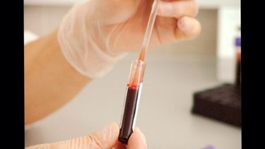 El aumento de ciertos tipos de glóbulos blancos y una respuesta inmunológica antiinflamatoria compensatoria podrían relacionarse con la depresión.