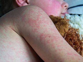 El sarampión es una enfermedad viral muy contagiosa que puede ser grave en bebés, niñas y niños pequeños, y hasta puede provocar la muerte.