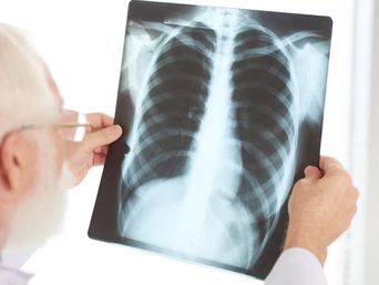 Cuando un nódulo es pequeño, como el que tendría el papa León XIV, la probabilidad de que se trate de un cáncer es baja.