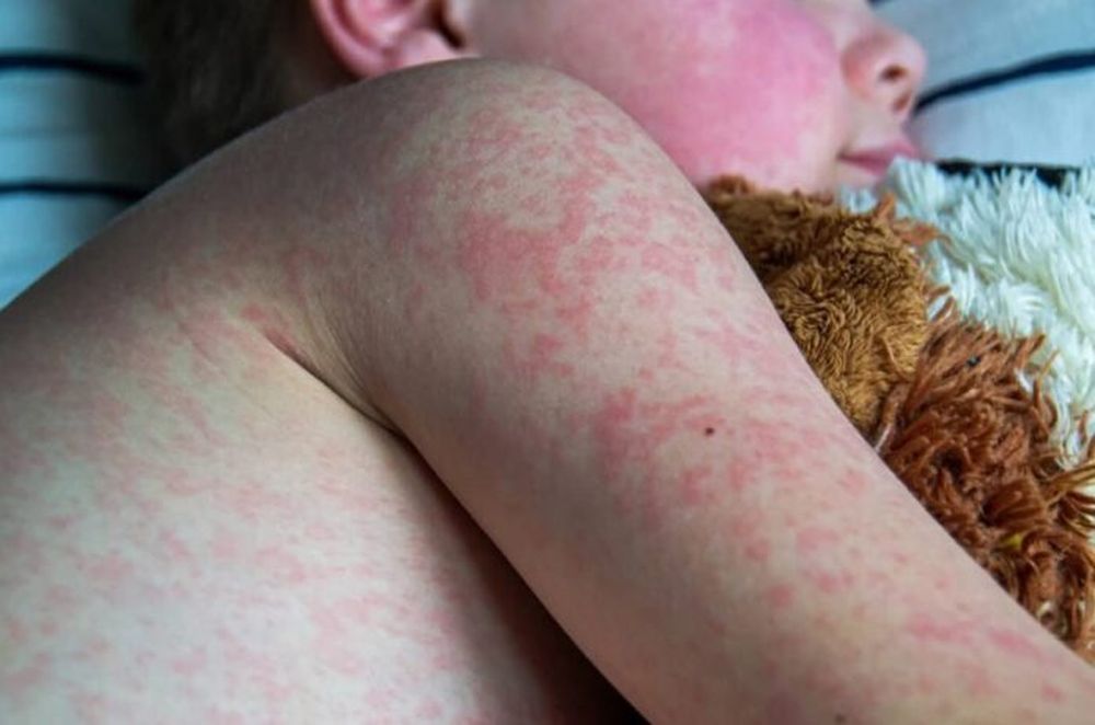 El sarampión es una enfermedad viral muy contagiosa que puede ser grave en bebés, niñas y niños pequeños, y hasta puede provocar la muerte.