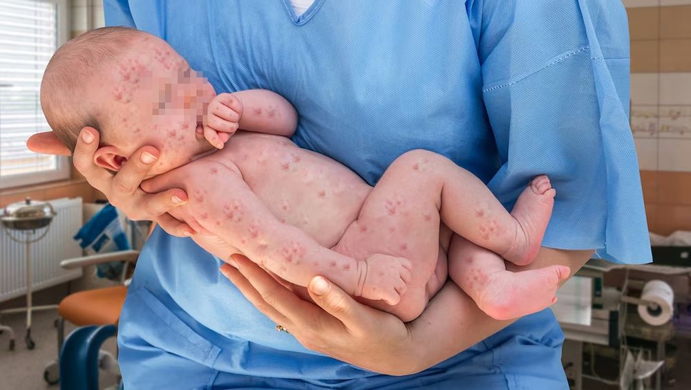 El sarampión en niños pequeños puede llegar a ser mortal. 