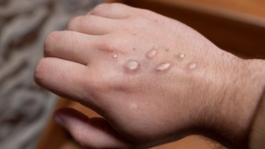 La erupción característica que causa la viruela del mono.