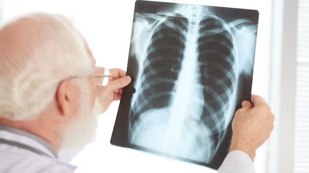 Cuando un nódulo es pequeño, como el que tendría el papa León XIV, la probabilidad de que se trate de un cáncer es baja.