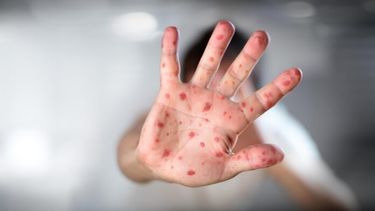 La hidradenitis supurativa es una enfermedad inmunológica, inflamatoria, crónica y recurrente de la piel que suele manifestarse luego de la pubertad.