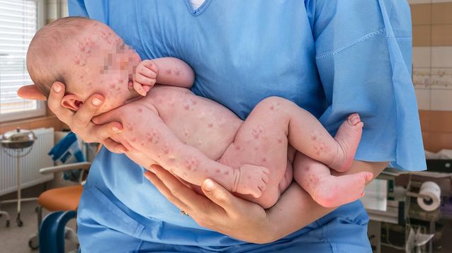 El sarampión es una enfermedad viral muy contagiosa que puede ser grave en bebés, niñas y niños pequeños, y hasta puede provocar la muerte.