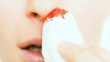 Diarios Bonaerenses | La hemofilia es una enfermedad hemorrágica hereditaria que se caracteriza por la aparición de hemorragias internas y/o externas que se producen por la deficiencia parcial o total de una proteína coagulante denominada globulina antihemofílica.