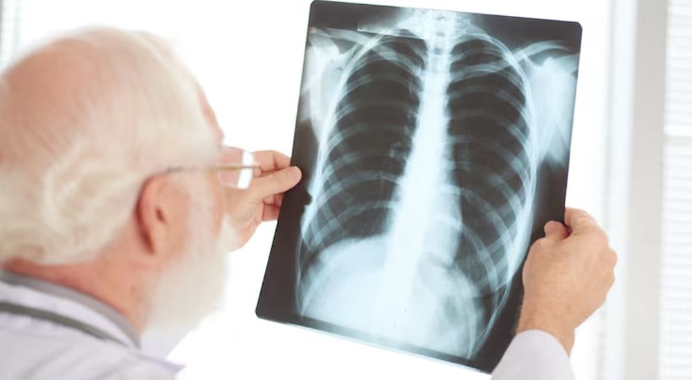 Cuando un nódulo es pequeño, como el que tendría el papa León XIV, la probabilidad de que se trate de un cáncer es baja.