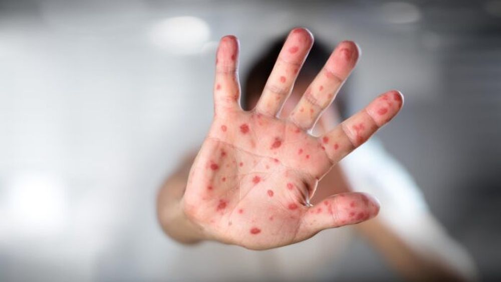 La hidradenitis supurativa es una enfermedad inmunológica, inflamatoria, crónica y recurrente de la piel que suele manifestarse luego de la pubertad.