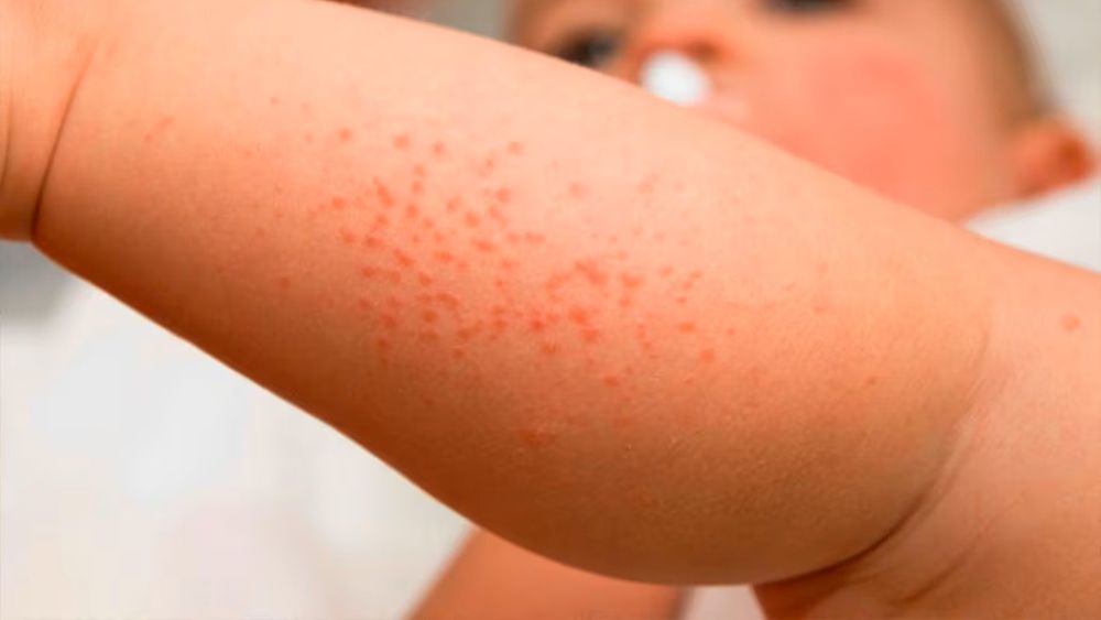 La dermatitis atópica afecta al diez por ciento de los niños y adolescentes, y en muchos casos llega hasta la adultez.