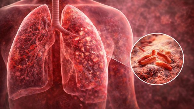 En 2025 se registraron más de 17 mil casos de tuberculosis en nuestro país.&nbsp;
