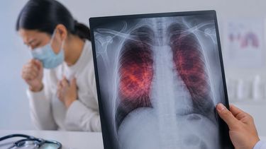 Si bien existe la vacuna BCG y hay antibióticos para curar la tuberculosis, los casos siguen en aumento en el país.&nbsp;