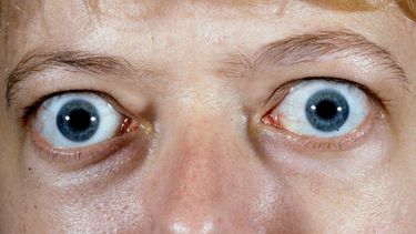 El impacto más evidente de la enfermedad ocular tiroidea son los ojos saltones.