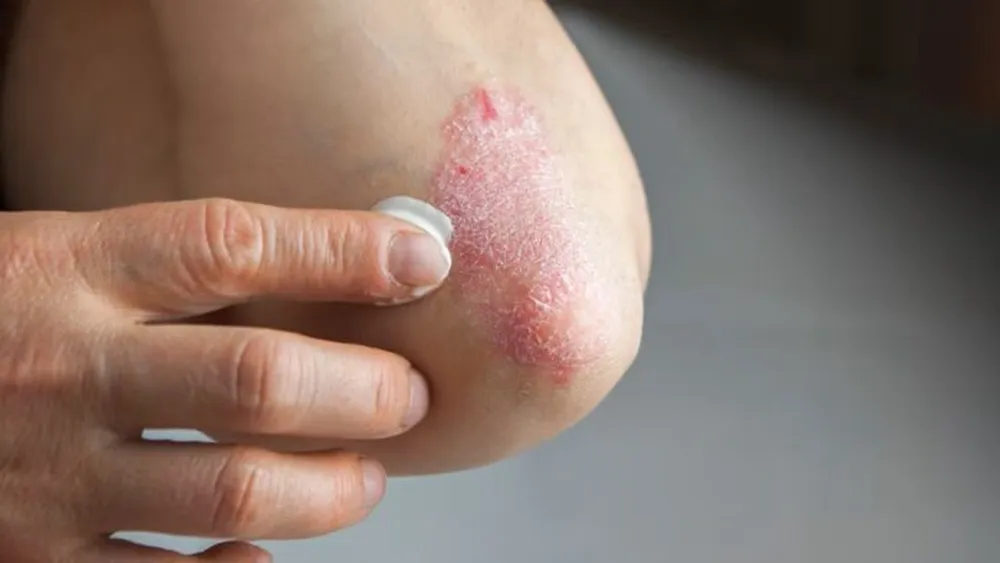 Más del 20% de las personas con psoriasis en Argentina presenta formas severas de la enfermedad.