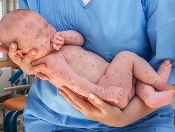 El sarampión es una enfermedad viral muy contagiosa que puede ser grave en bebés, niñas y niños pequeños, y hasta puede provocar la muerte. El sarampión es una enfermedad viral muy contagiosa que puede ser grave en bebés, niñas y niños pequeños, y hasta puede provocar la muerte.