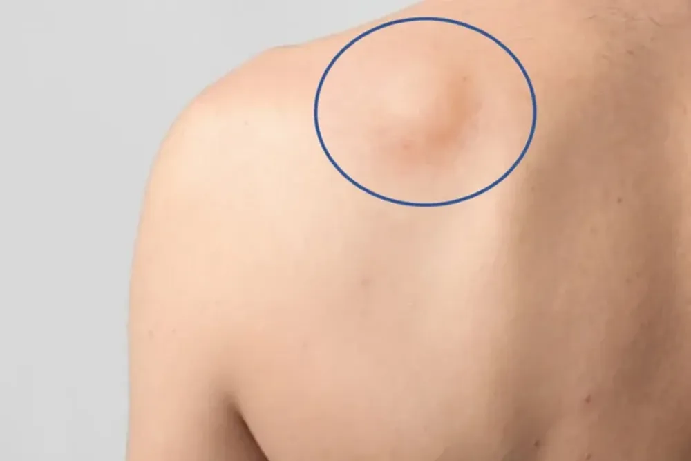 Es un término amplio para describir cánceres que comienzan en tejidos blandos o en tejido óseo.