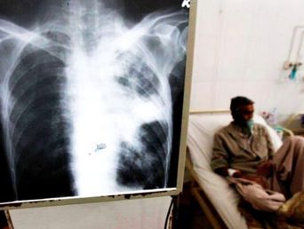 Los casos de tuberculosis aumentaron considerablemente entre 2020 y 2025 en el país. Los casos de tuberculosis aumentaron considerablemente entre 2020 y 2025 en el país.
