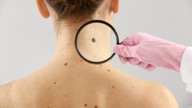 Si se lo detecta precozmente, el cáncer de piel se puede curar.