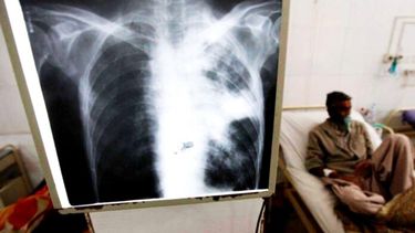 Los casos de tuberculosis aumentaron considerablemente entre 2020 y 2025 en el país.