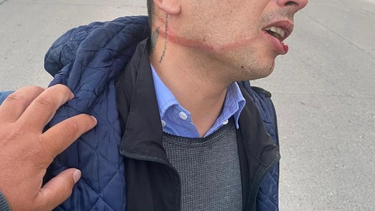 El motociclista asaltado muestra la tremenda marca que le dejó el cable suspendido sobre la calle.