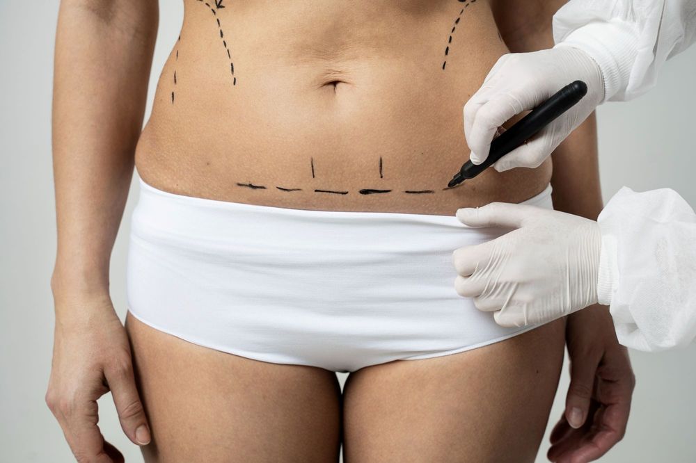 La diástasis abdominal es una separación de los músculos rectos que puede afectar tanto la estética como la función del abdomen.