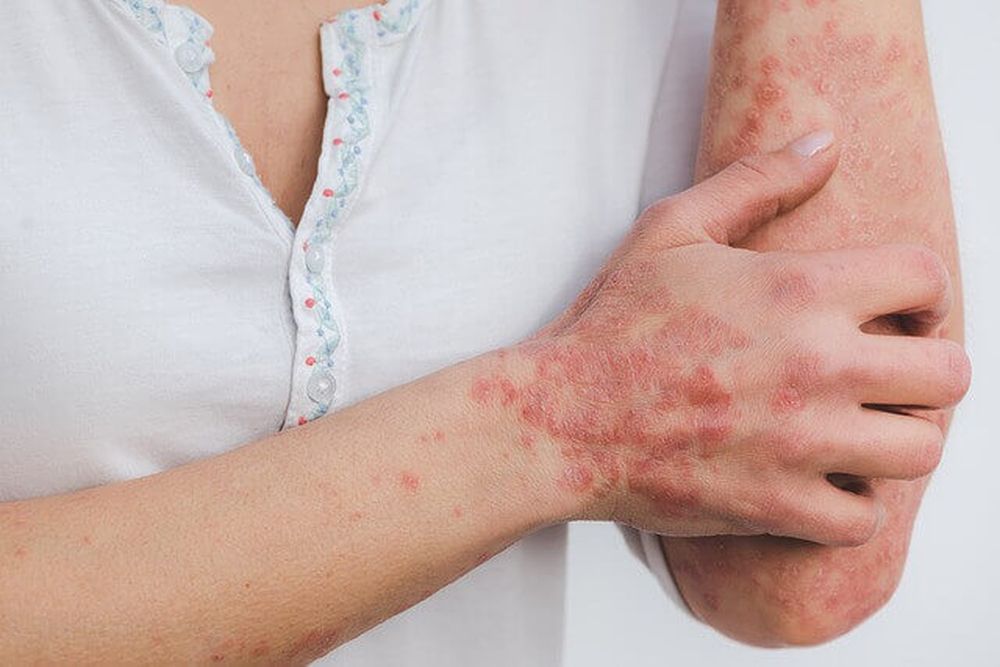 La enfermedad psoriásica es una afección crónica, inflamatoria, no contagiosa del sistema inmunológico que puede afectar no solo a la piel (psoriasis), sino también a las articulaciones (artritis psoriásica).