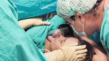 Momento del nacimiento de la pequeña que había sido intervenida quirúrgicamente antes de nacer. (Hospital Garrahan)