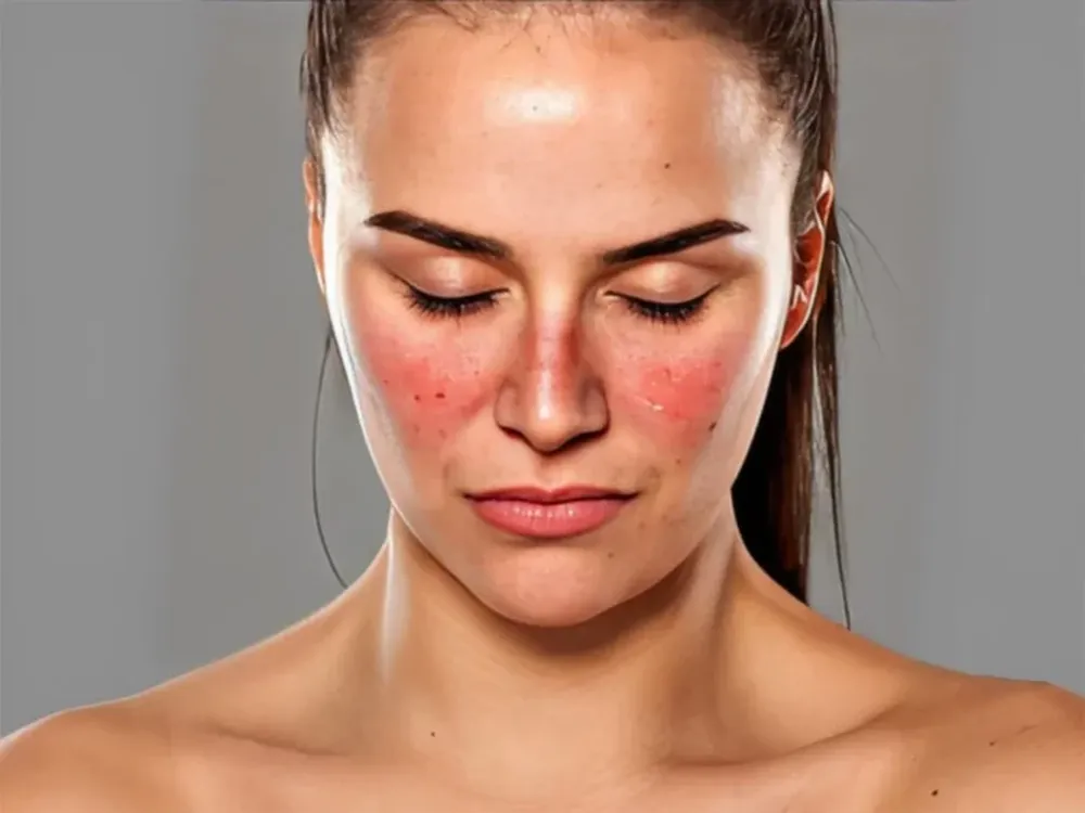 El Lupus es una enfermedad autoinmune e inflamatoria que afecta a más de cinco millones de personas en todo el mundo.