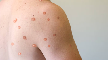 La viruela símica se contagia por contacto piel con piel con otras personas y las gotículas que se exhalan al respirar o toser.