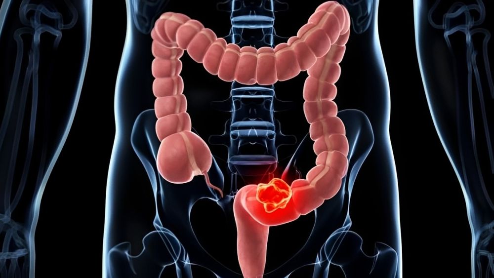 Nueva campaña para prevenir el cáncer de colon.