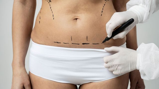 La diástasis abdominal es una separación de los músculos rectos que puede afectar tanto la estética como la función del abdomen.