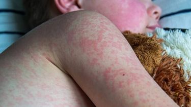 El sarampión es una enfermedad viral muy contagiosa que puede ser grave en bebés, niñas y niños pequeños, y hasta puede provocar la muerte.